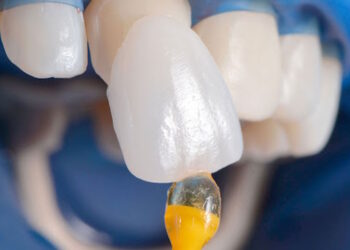 Вініри: секрети довговічності