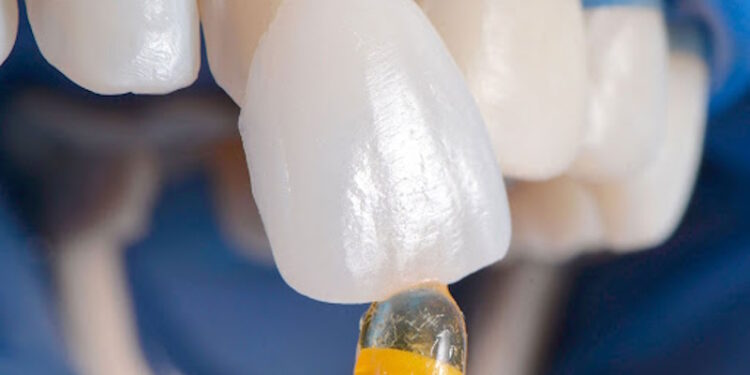 Вініри: секрети довговічності