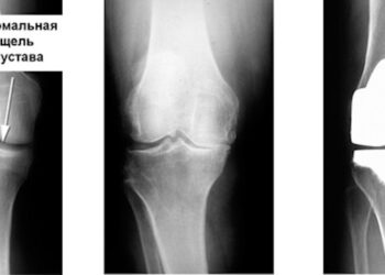 эндопротезирование колена