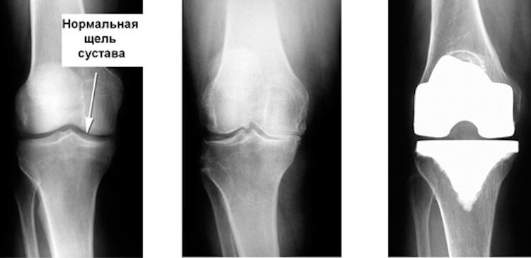 эндопротезирование колена